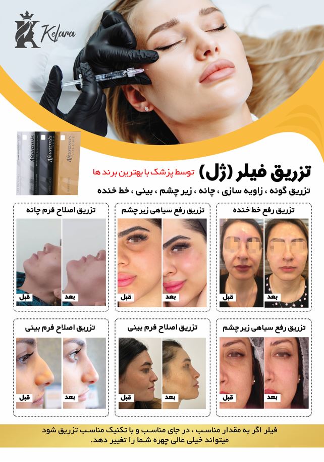 تزریق فیلر صورت